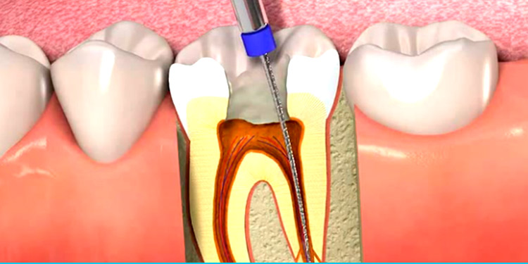 Endodontia na Zona Oeste